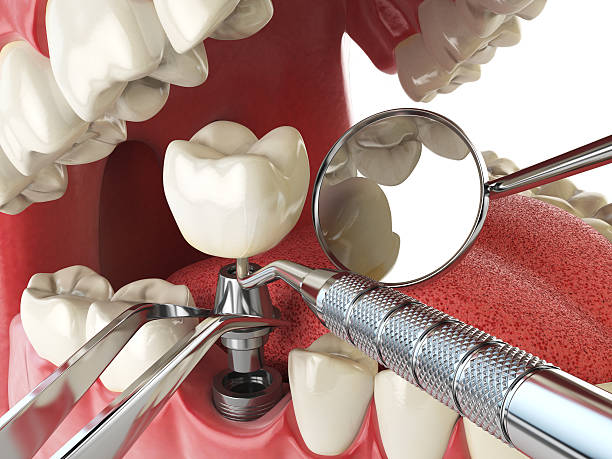 Best Knocked-Out Tooth (Avulsed Tooth) Treatment in Burlington, ND