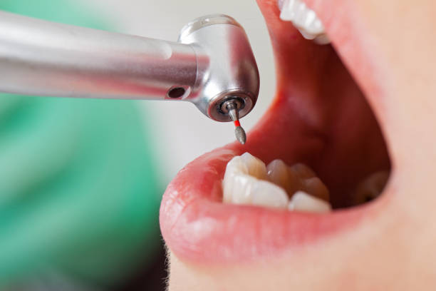 Best Broken or Chipped Tooth Repair in Burlington, ND